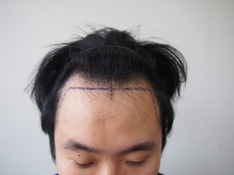 M字脱发植发照片后记