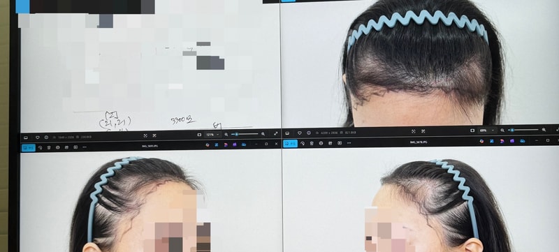 모프로의원, 헤어라인이식, 수술 당일