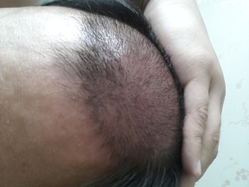 釜山韩商报毛发移植的第三天~