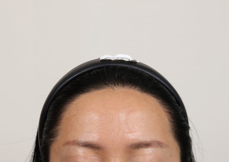 부산모발이식 슬릿방식 맘모스 헤어라인교정 11개월 경과