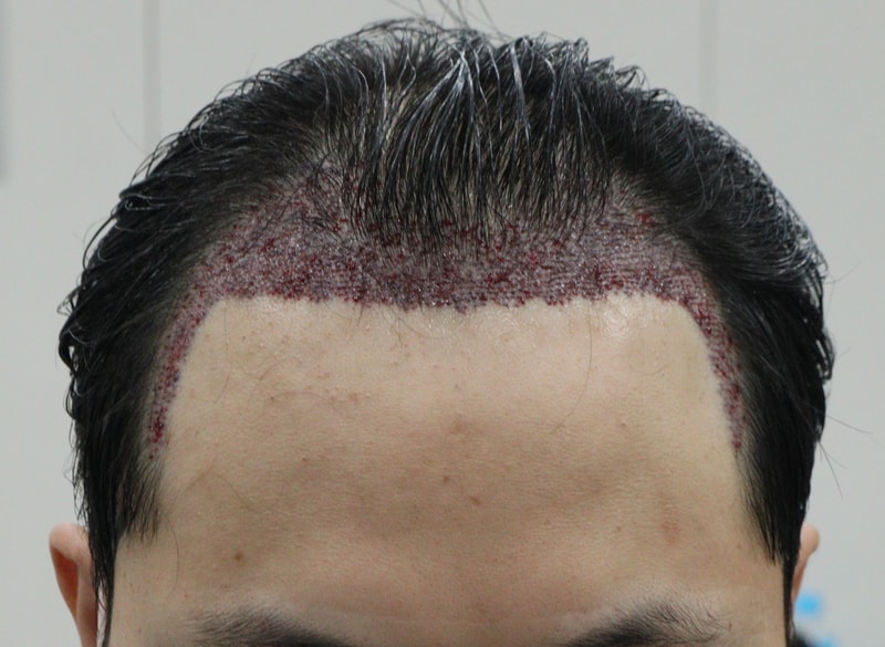 2. 수술후_당일.JPG
