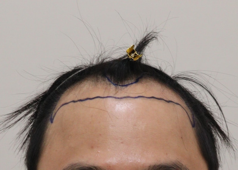 삭발하고 모발이식 하고 왔습니다