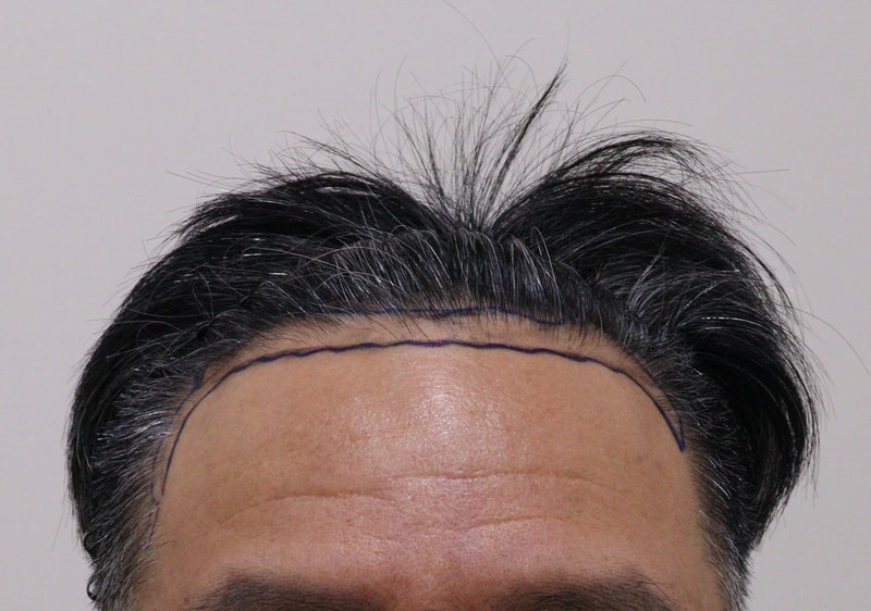 처음으로 글 써봅니다. 모발이식 했습니다.