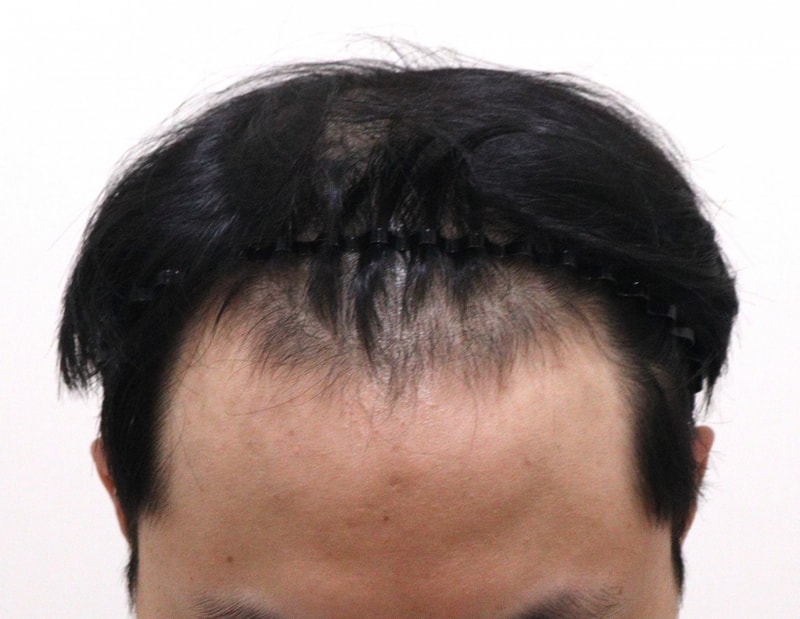 1. 수술전_2.JPG