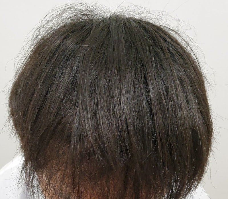 3. 수술후_3개월_1.jpg