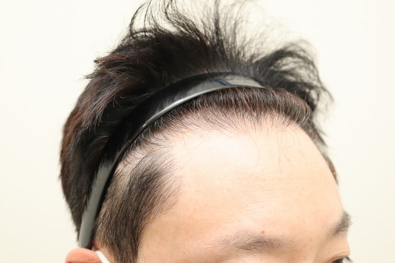 1. 수술전_3.JPG