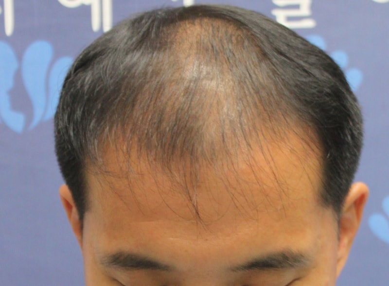 시술전 제모습.JPG