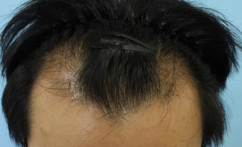 Transplantation of m-shape and hairline in Hannaive