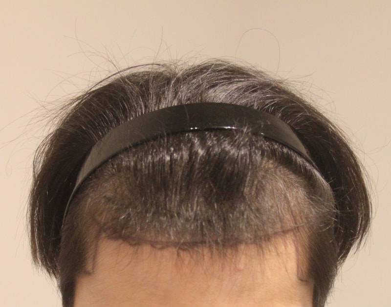 Non-cut hair transplant 1430 hair follicles 9 months later