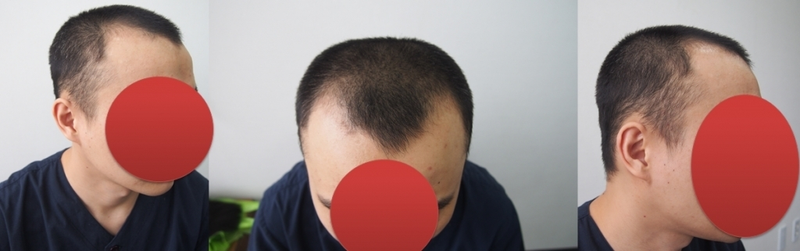 M-shaped hair transplant + Gouretnaru non-cut 6653 hair 2617 hair follicles [2nd week]