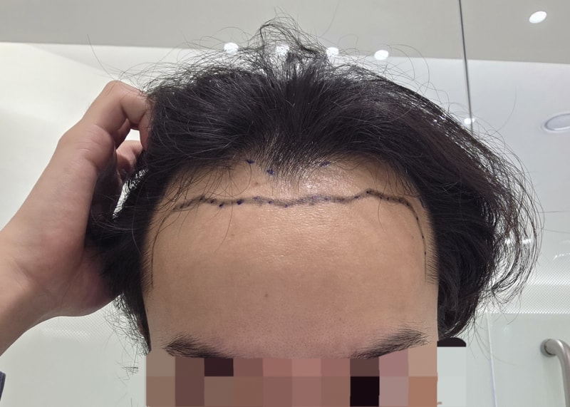 4500모 비절개 삭발 모발이식