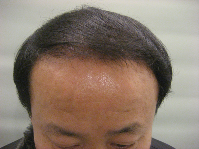 수술후.png