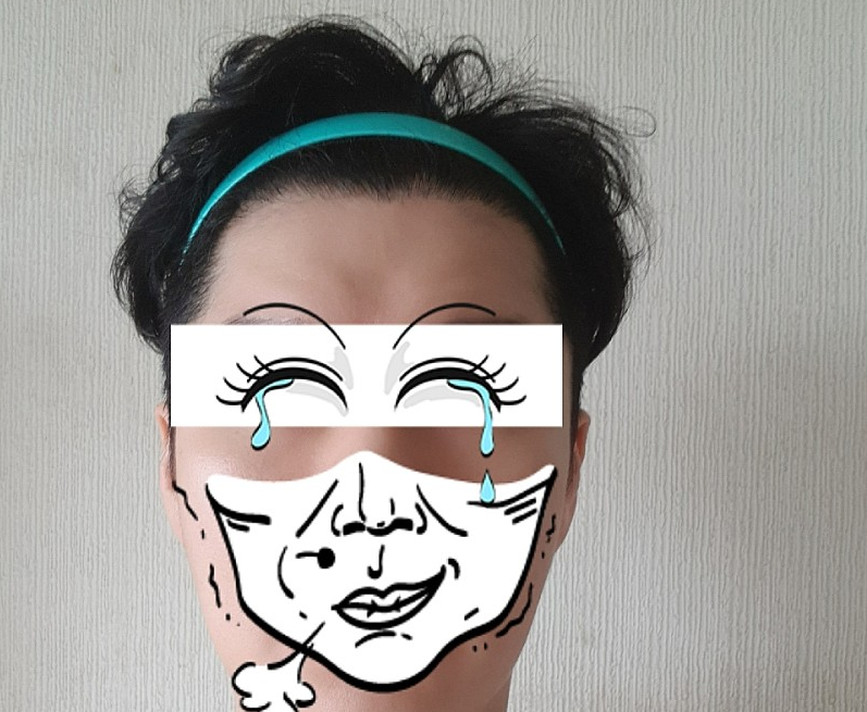<두드림 성형외과> 비절개모발이식 3000모 6개월차 입니다.