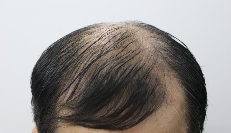 Not long ago, I had surgery at Lizmo in Busan Hair Transplantation Center and was so satisfied.