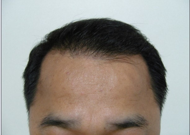 수술후4개월반.jpg