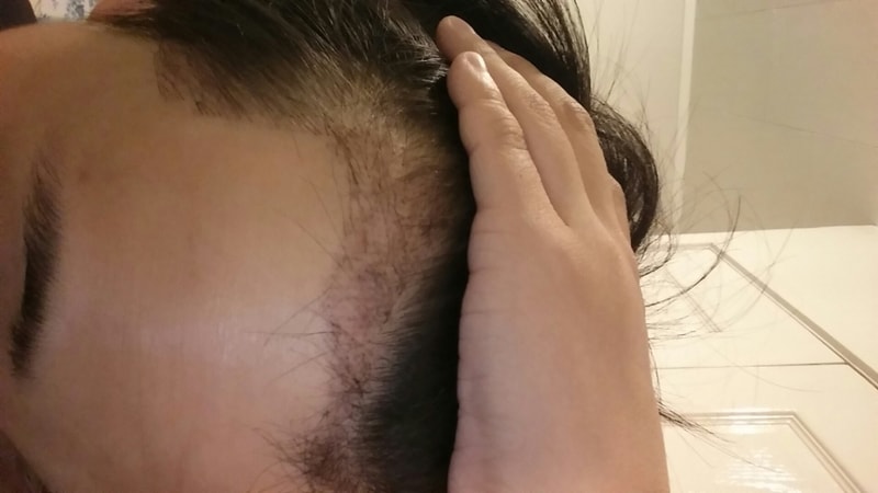 Motion) M-shaped and hairline 1200 hair follicles 80th day review