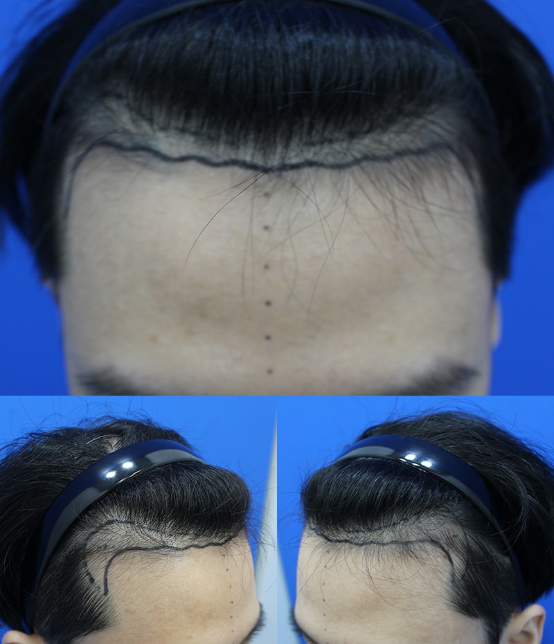 2200毛 5ヶ月体験談(ショックロスが過ぎて育つ中)