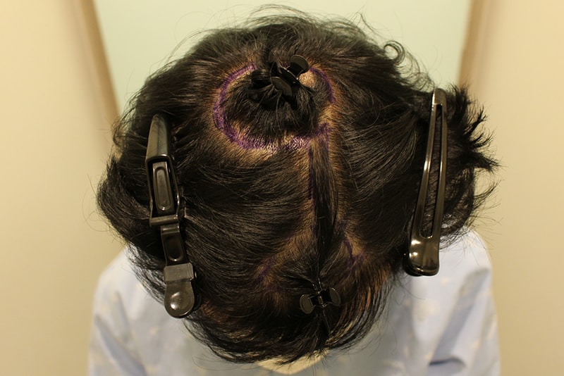The second hair transplant was done at a re-surgery hospital