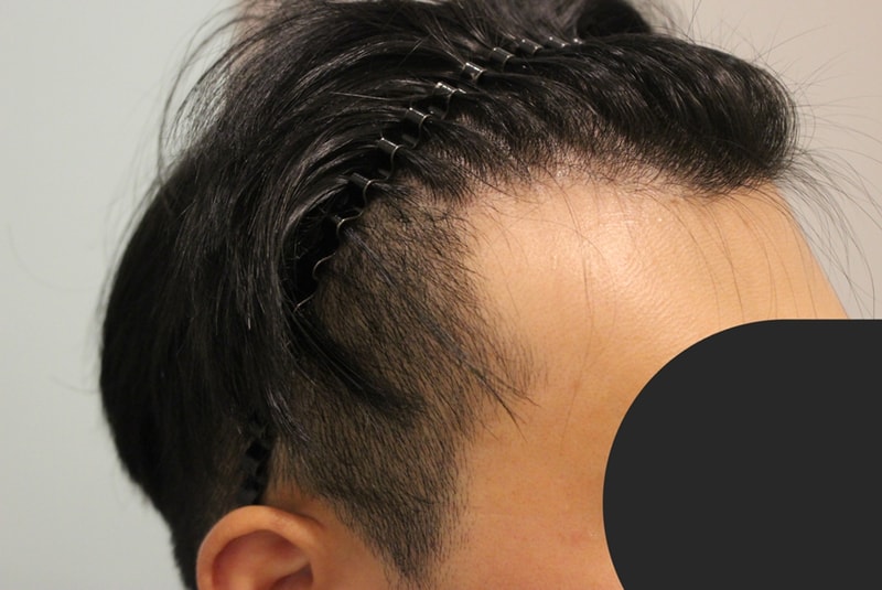 양쪽에 넓은 엠자+ 측면 라인에 이식