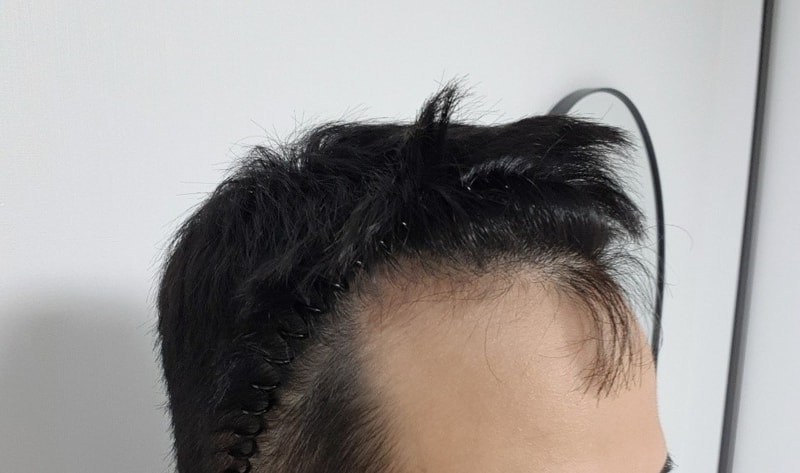 수술전깊은M자.jpg