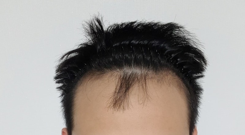 수술전정면.jpg