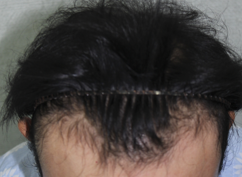 M-shaped incision, 3600, leave a review of the first year