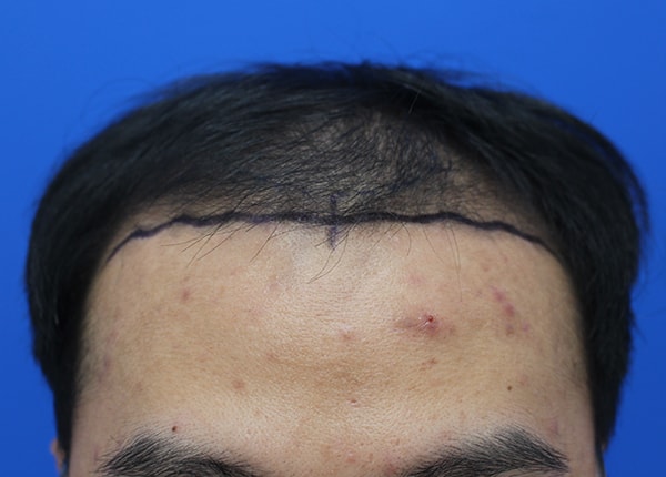 앞머리 복구 성공, 저.. 졸업하겠습니다. (3000모 1년)