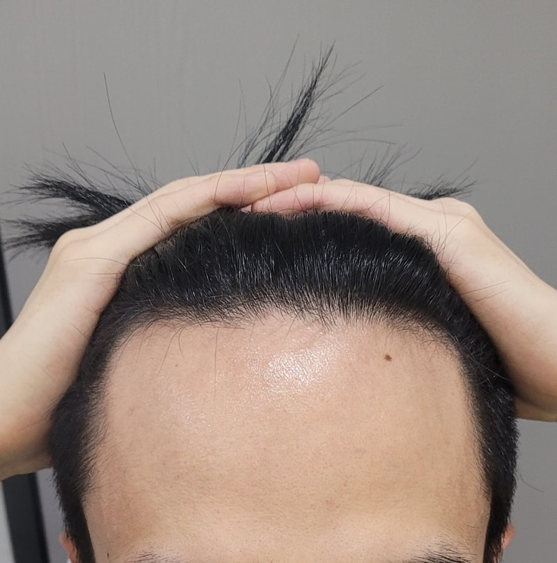 继父亲之后，我也在Dana接受了毛发移植。 大概有1个月了