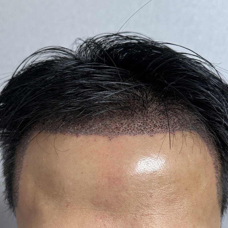 Dana's foot transplant 2300 hair follicles 1 day later