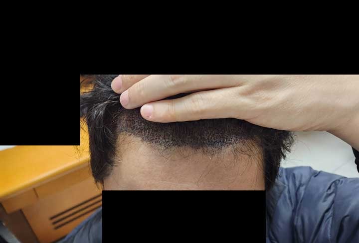 수술3일앞모습.jpg