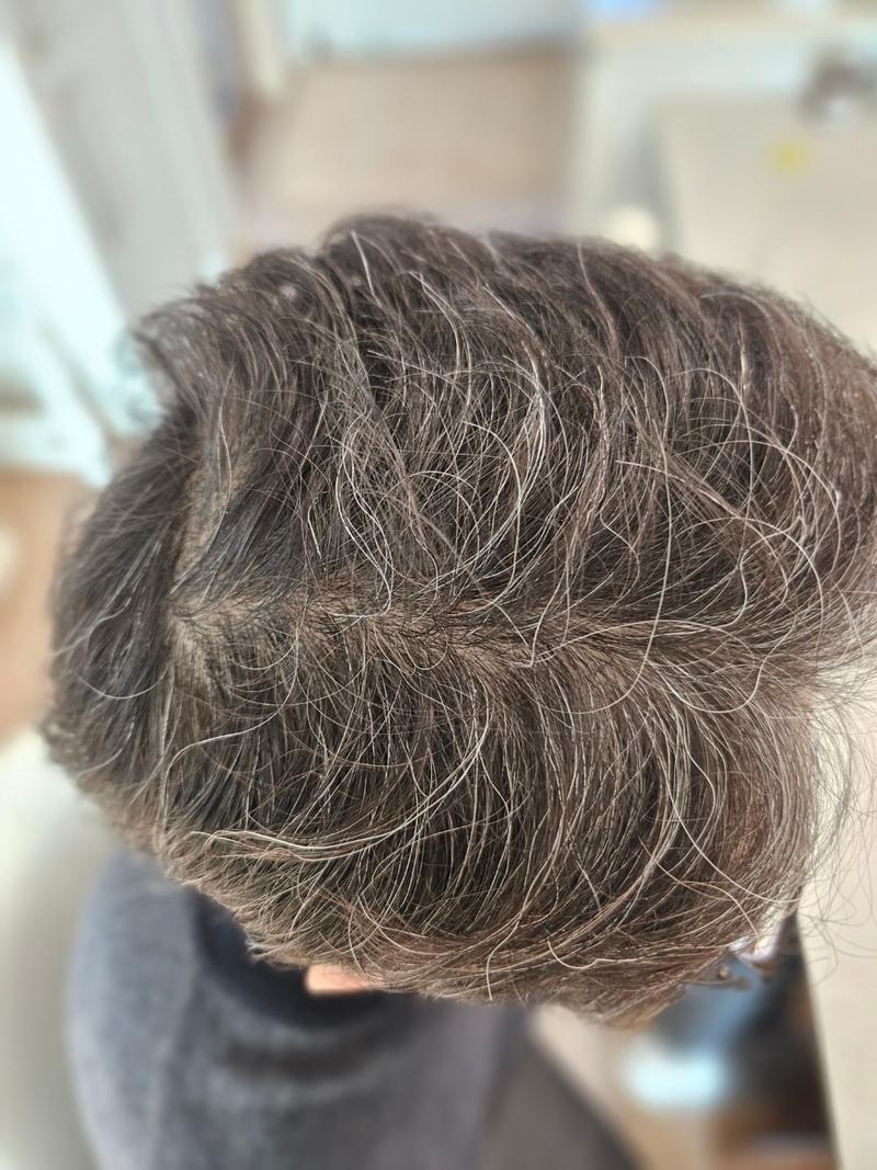 Dana plastic surgery surgery Emza hair loss and crown hair loss hair transplantation are in the late 14 months.