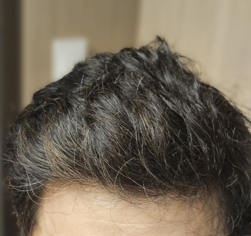 Dana's hairless transplant 2300 hair follicles for 8 months