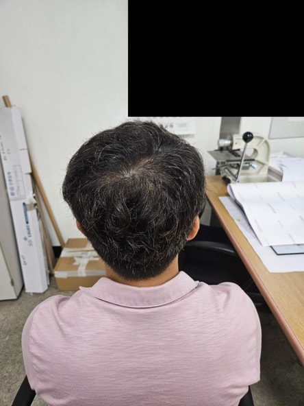 다나성형외과 비절개모발이식 20개월(m자+정수리)