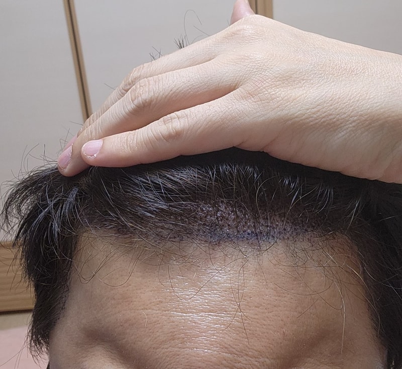 MJ, do it at Dana's hair loss and 11 months