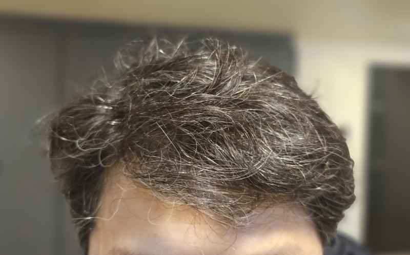 Dana Plastic Surgery M-shaped hair loss + regular hair loss hair transplantation is in the late 15 months.