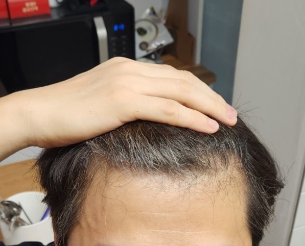 Dana Plastic Surgery Surgery Non-Cutted 2300 Hair follicles for 3 months.