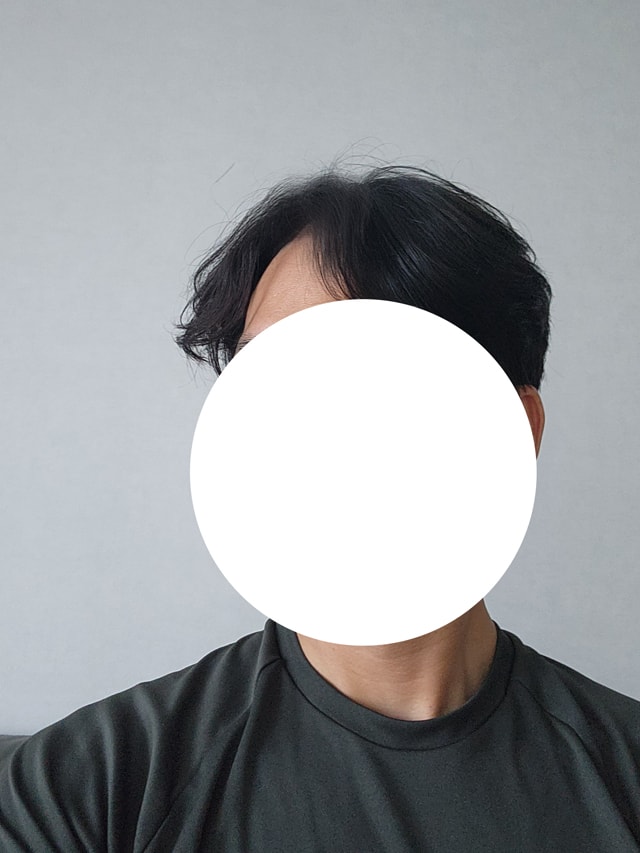 모발이식 25개월.jpg