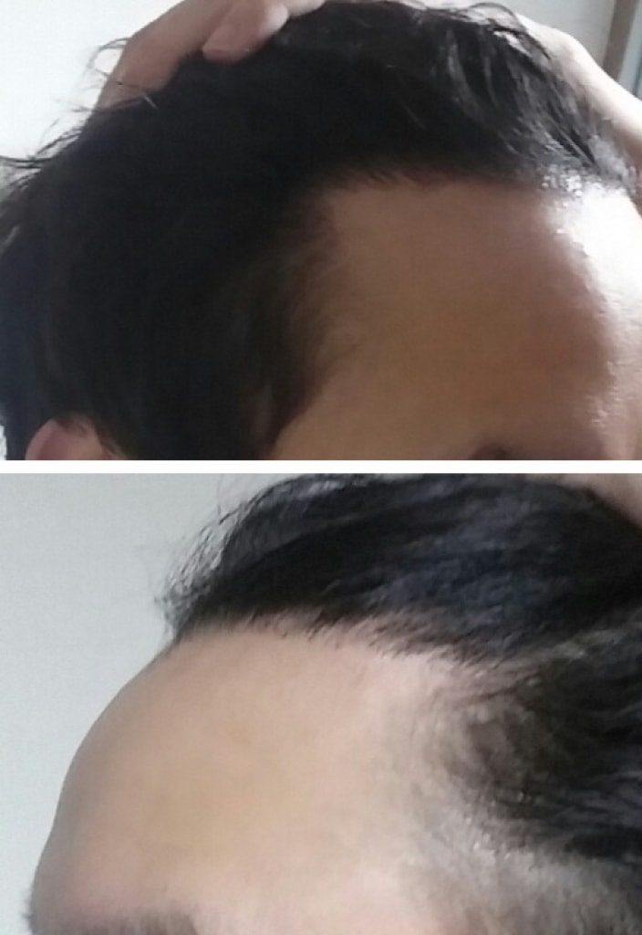 모션 1400모낭 비절개 6개월 후기