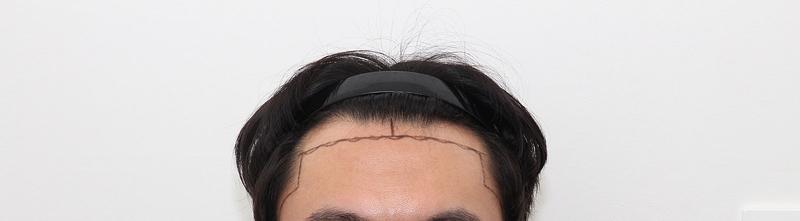 New hair incision / M-shape / 1800 hair follicles / Year 1 review