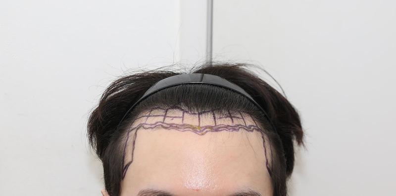 New Hair Non-Cutting Hair Transplantation 2000 Hair follicle 3 Months Late