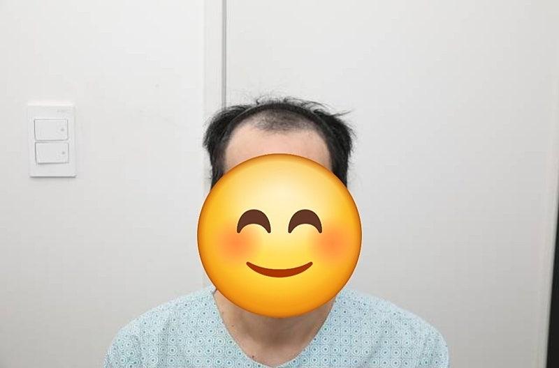 뉴헤어 M자 절개 모발이식 2000모낭 1년차 후기