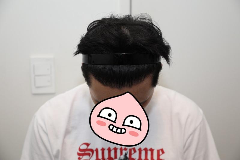 뉴헤어 절개 모발이식 1년차후기