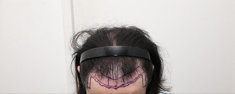 ニューヘアソウル店 毛髪移植 切開 2000毛包9ヶ月目のレビュー