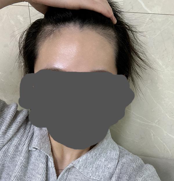 모플러스 비절개 2000모 헤어라인 수술 554일 후기