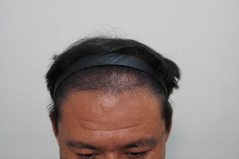 Director Jang Tae-ho of Grow Clinic (formerly New Hair Busan Branch)'s hair transplant 4,000 mother 6 months later