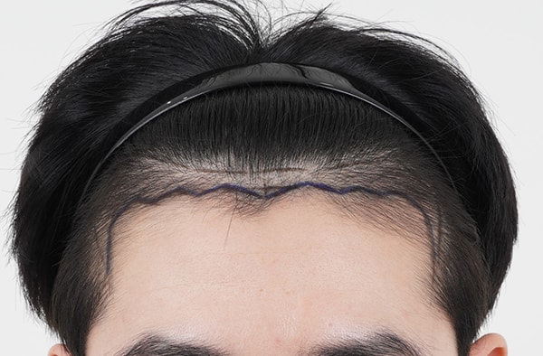 モモクリニック水原店 ムン·ヒョソプ院長に鼻切開2600本のM字移植を受けました。