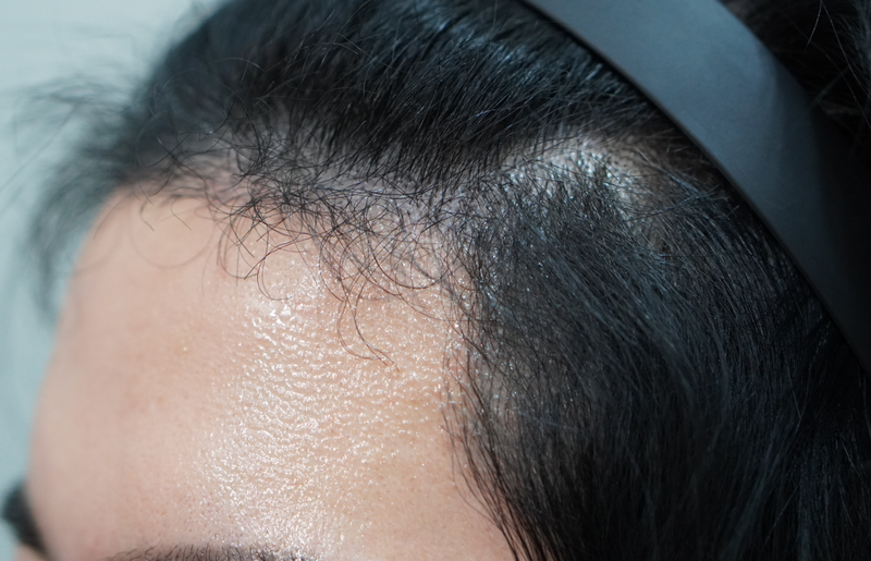 Councilman Grow (formerly New Hair Busan) Hairline 2000 Mo 6 Months Late