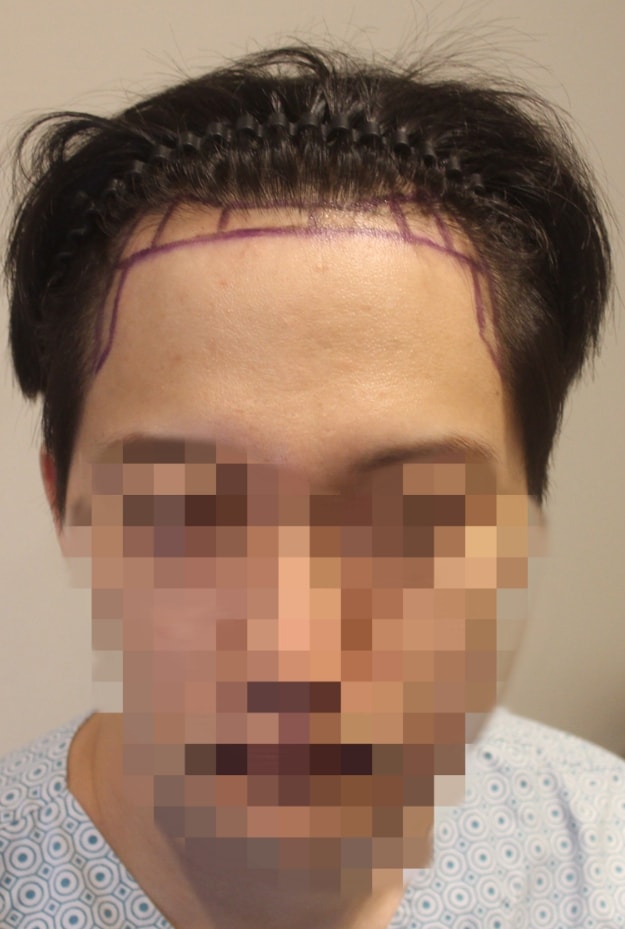 New Hair Hair Plastic Surgery Seoul Branch Hair Transplantation Non-Cutting 1100 Hair Orthopaedes 1 Year Late