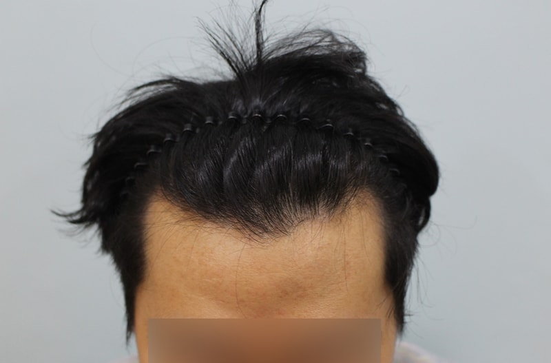チャームドクターヘアライン、1年以上の本当にすっきりとした結果を残します。