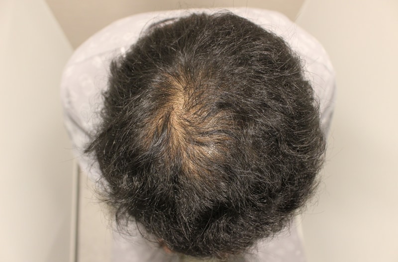 I got a hair transplant on the top of my head